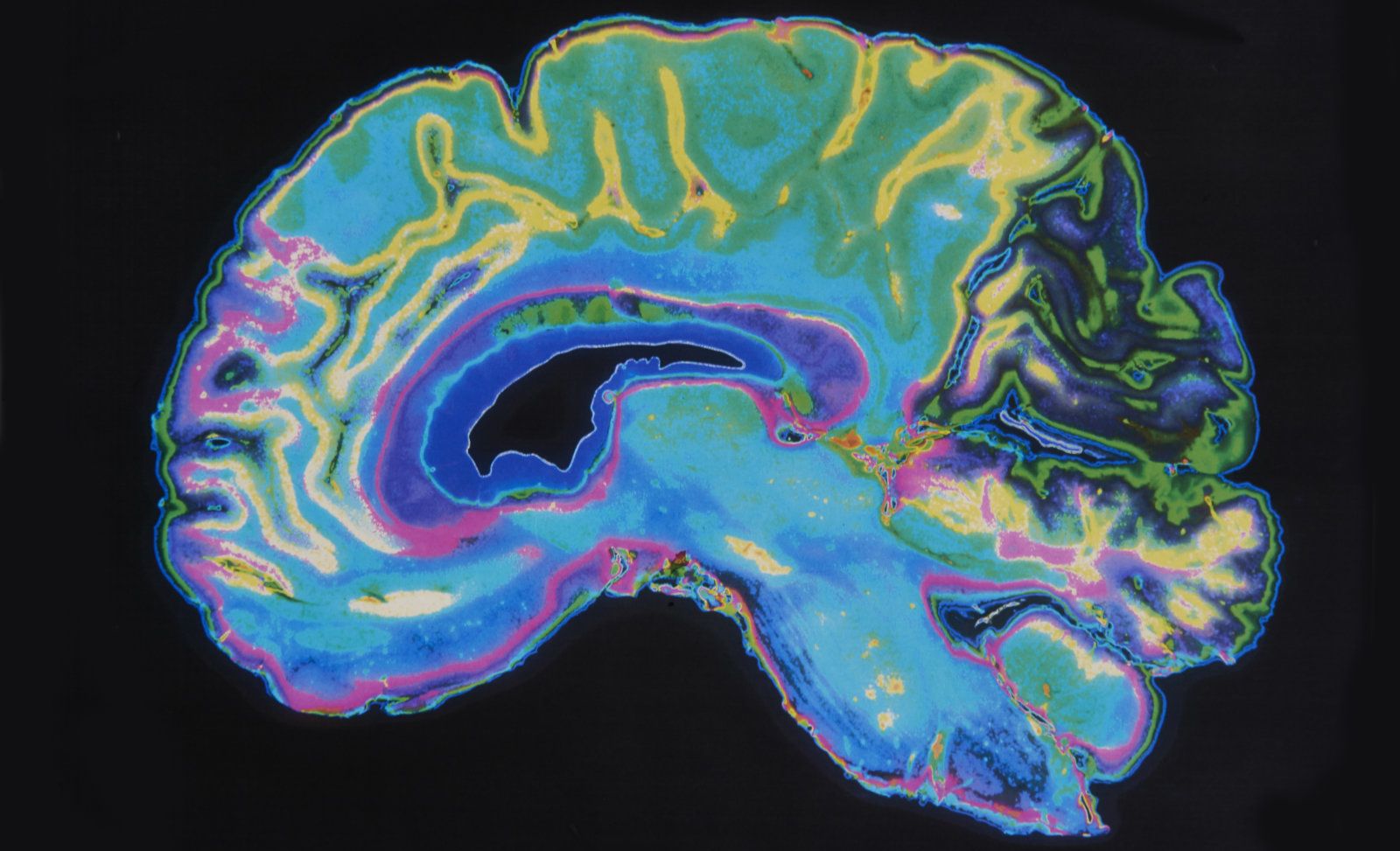 Штучний інтелект навчився виявляти ранні симптоми шизофренії