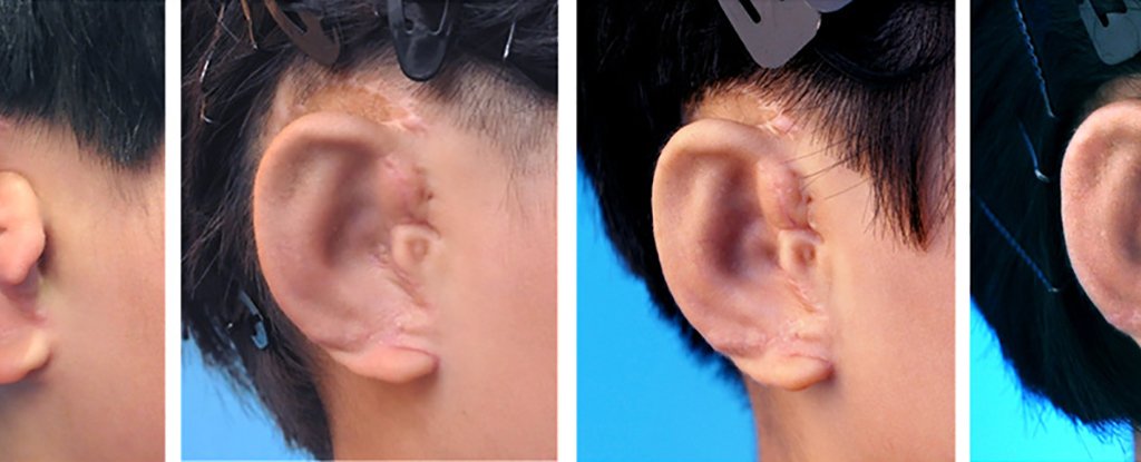 У Китаї успішно проведені унікальні операції по відновленню вух дітям
