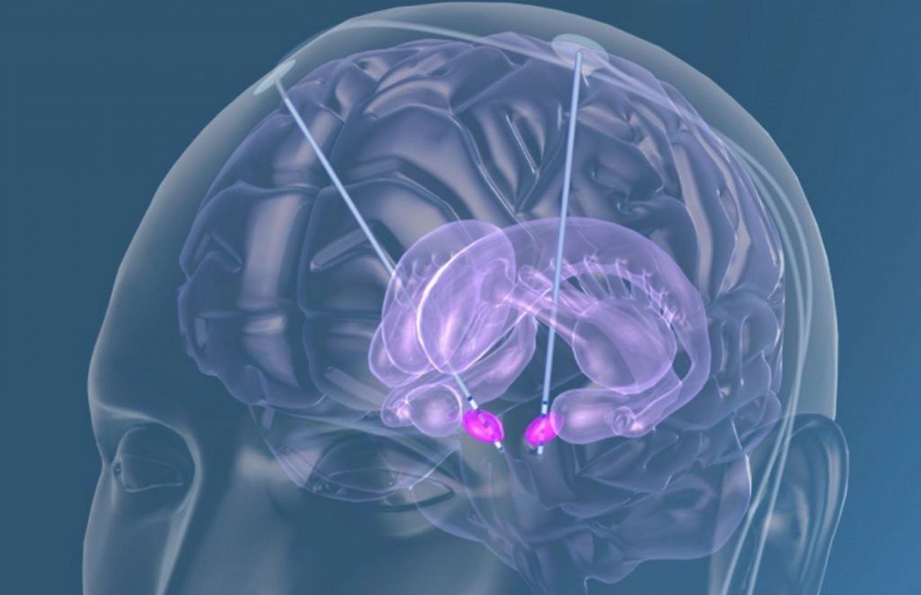 Bilim adamları ilk kez kazanmış bellek Alzheimer hastalığı