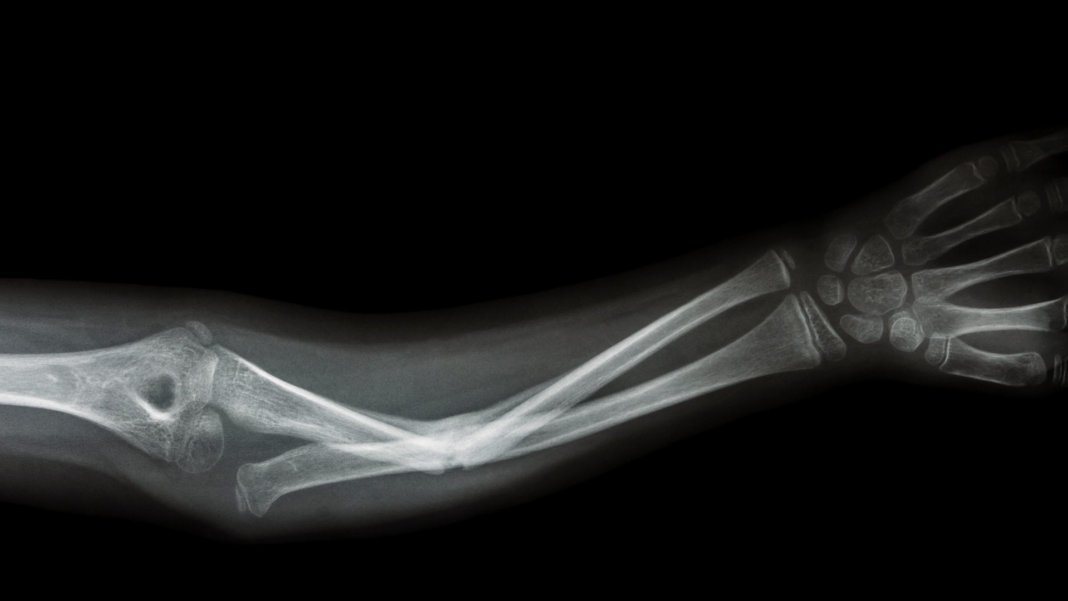 Grafen obiecuje szybciej naprawić złamane kości, a nawet zapobiec złamania