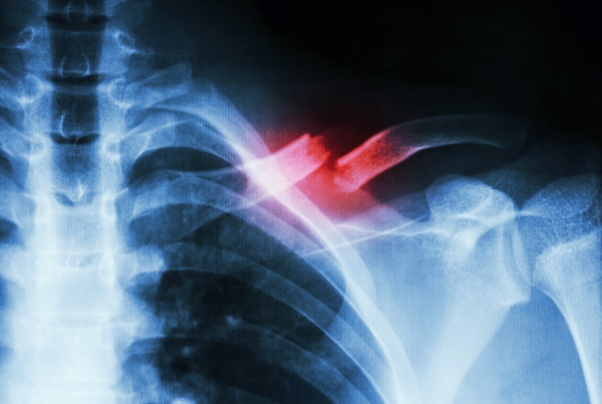 प्रयोगात्मक उपचार मदद कर सकते हैं कई गुना तेजी से सुधार करने के लिए टूटी हुई हड्डियों