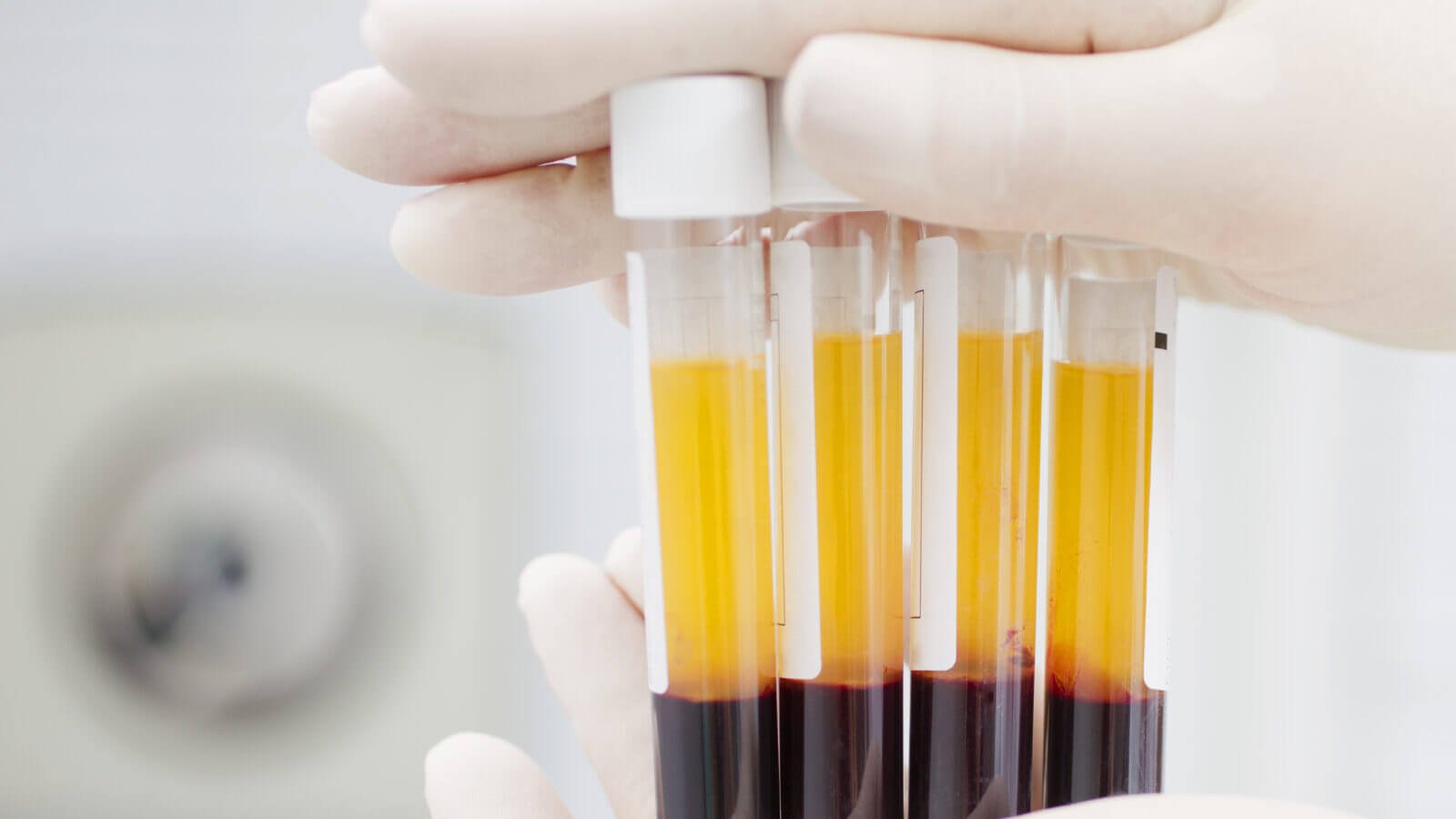 Se a transfusão de plasma de sangue curar coronavírus?