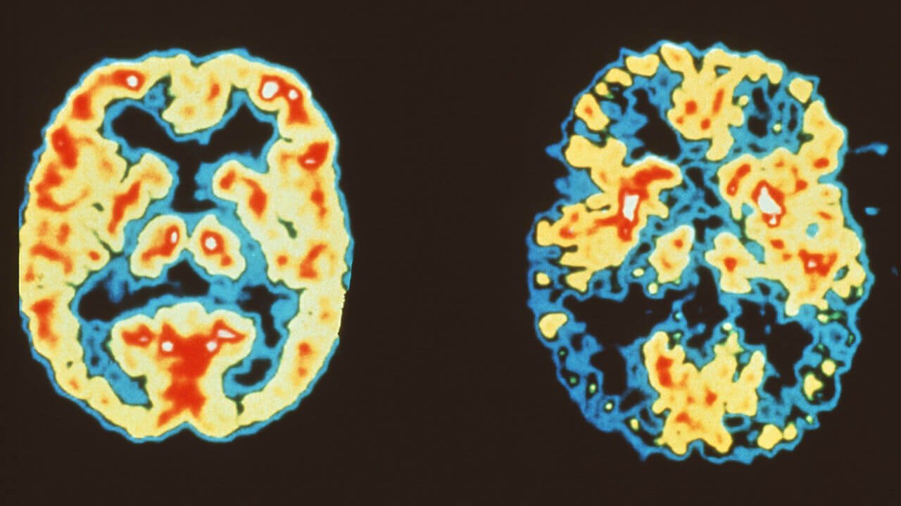 Wiederkehrende negative Gedanken gebunden mit Alzheimer-Krankheit