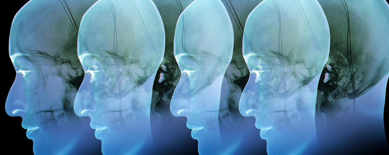 Elektroden im Gehirn: kann man Adipositas zu behandeln?