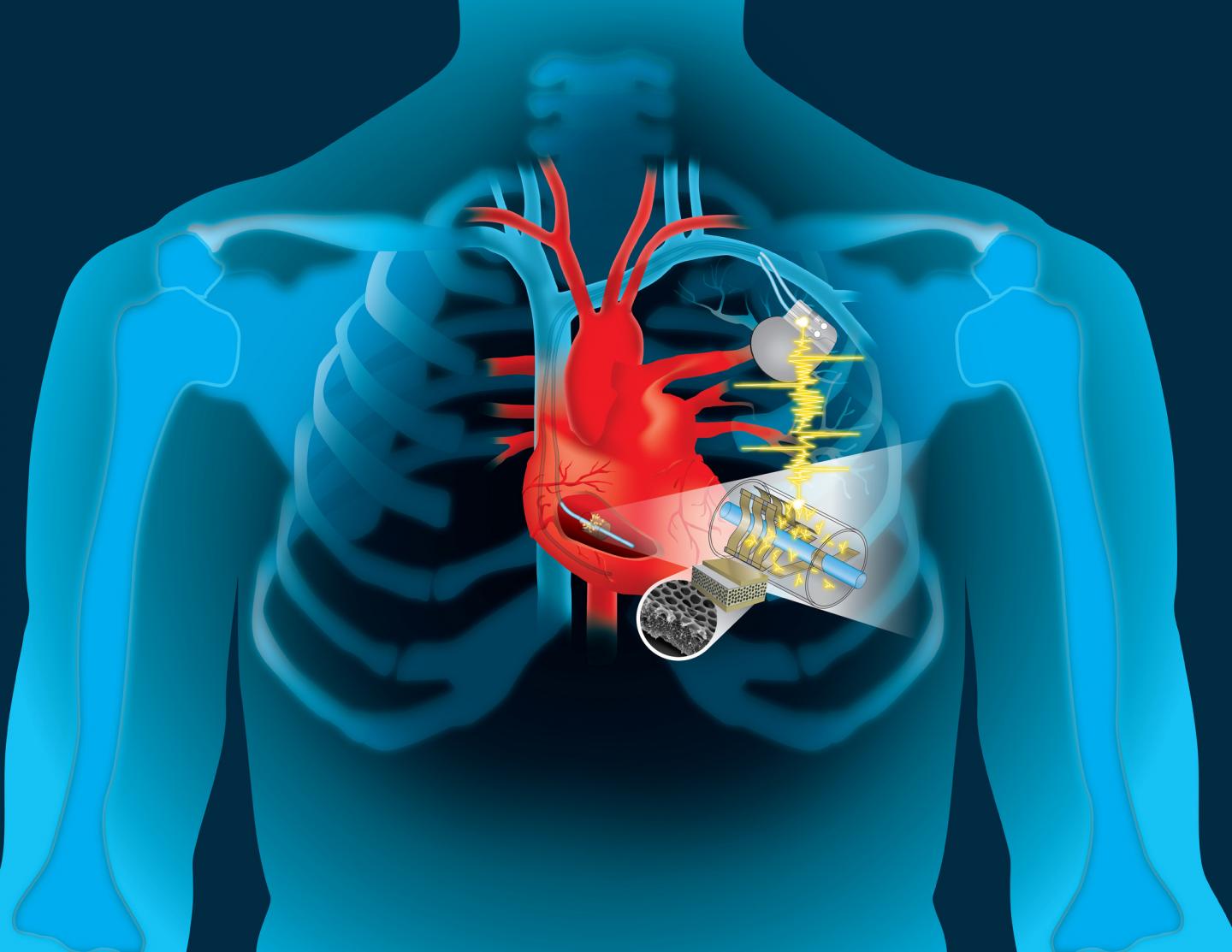 永恒的动机：能源中心可以使用心脏起搏器充电