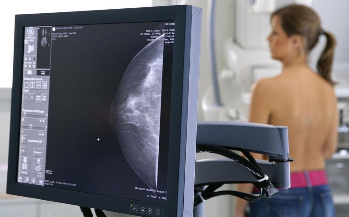 Artificial intelligence detects breast cancer better than a professional doctor