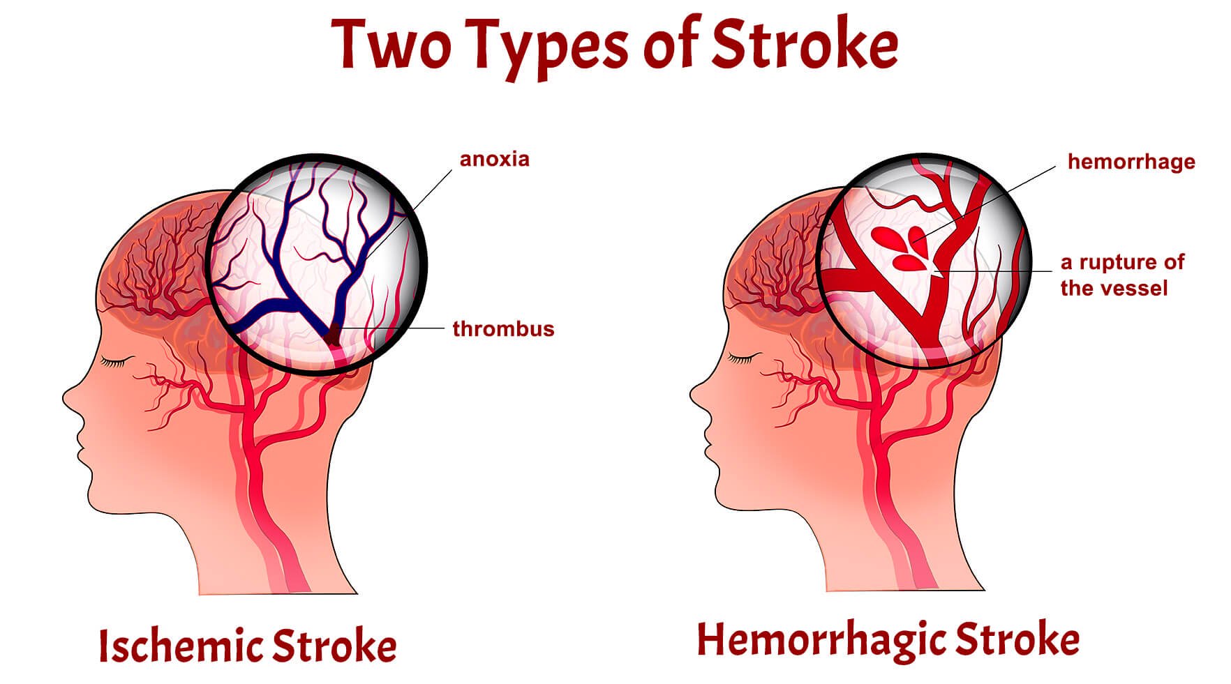 What Types Of Stroke Exist And Why They Happen 